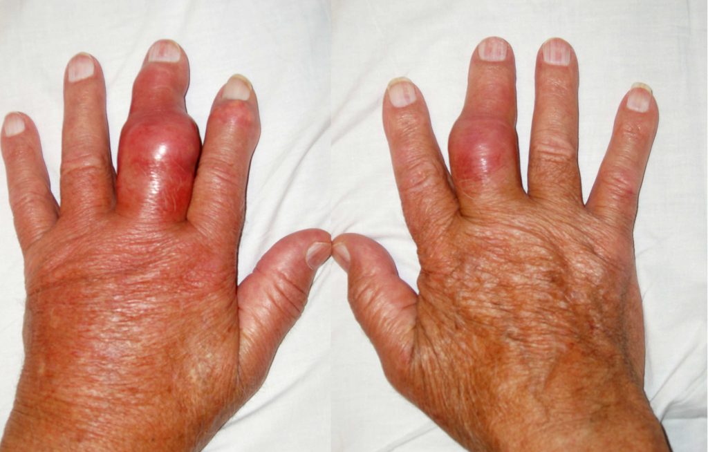 Various Types of Joint Pain